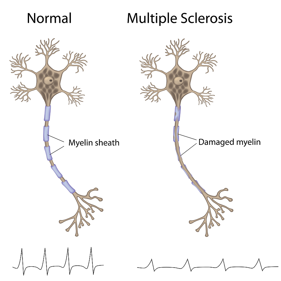 multiple-sclerosis